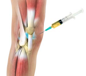 PRP (Platelet Rich Plasma) Tedavisi
