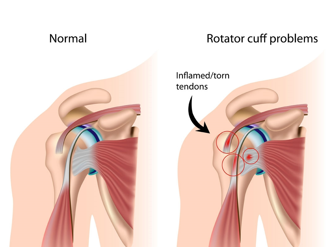 Rotator cuff yırtığı ve geçmeyen omuz ağrısı 